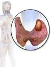 Photo for Hyperparathyroidism – Market Insights, Epidemiology and Market Forecast-2023