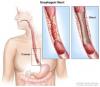 Photo for Esophageal Cancer – Market Insights, Epidemiology and Market Forecast-2023