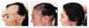 Photo for Alopecia – Market Insights, Epidemiology and Market Forecast-2023