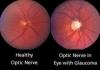 Photo for Glaucoma  – Market Insights, Epidemiology and Market Forecast-2023