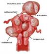 Photo for Uterine fibroids – Market Insights, Epidemiology and Market Forecast-2023