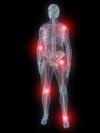 Photo for Neuropathic  Pain – Market Insights, Epidemiology and Market Forecast-2023