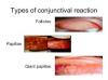 Photo for Allergic Conjunctivitis  – Market Insights, Epidemiology and Market Forecast-2023