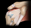 Photo for Global Orthobiologics Market Outlook 2020