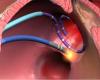 Photo for Atrial Fibrillation Surgery Market by Procedure - Global Forecast to 2020