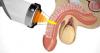 Photo for Erectile Dysfunction  – Market Insights, Epidemiology and Market Forecast-2023