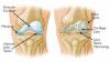 Photo for Osteoarthritis  – Market Insights, Epidemiology and Market Forecast-2023