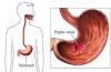 Photo for Peptic Ulcer  – Market Insights, Epidemiology and Market Forecast-2023