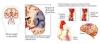 Photo for Fabry’s Disease  – Market Insights, Epidemiology and Market Forecast-2023