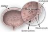 Photo for Interstitial Cystitis – Market Insights, Epidemiology and Market Forecast-2023