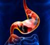 Photo for Gastric Cancer  – Market Insights, Epidemiology and Market Forecast-2023