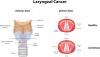 Photo for Larynx Cancer  – Market Insights, Epidemiology and Market Forecast-2023