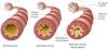Photo for Asthma – Market Insights, Epidemiology and Market Forecast-2023