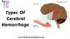 Photo for Brain Hemorrhage – Market Insights, Epidemiology and Market Forecast-2023