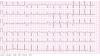 Photo for Atrial Fibrillation – Market Insights, Epidemiology and Market Forecast-2023
