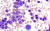 Photo for Chronic Myelocytic Leukemia (CML) – Market Insights, Epidemiology and Market Forecast-2023
