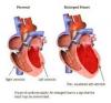 Photo for Chronic Heart Failure – Market Insights, Epidemiology and Market Forecast-2023