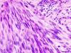 Photo for Gastrointestinal Stromal Tumors (GIST)- Market Insights, Epidemiology and Market Forecast-2023