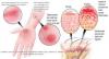 Photo for Eczema – Market Insights, Epidemiology and Market Forecast-2023