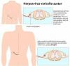 Photo for Herpes Zoster- Market Insights, Epidemiology and Market Forecast-2023