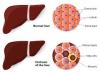 Photo for Liver Cirrhosis- Market Insights, Epidemiology and Market Forecast-2023