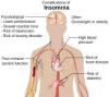 Photo for Insomnia – Market Insights, Epidemiology and Market Forecast-2023