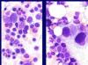 Photo for Myelodysplastic Syndrome- Market Insights, Epidemiology and Market Forecast-2023