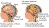Photo for Meningitis – Market Insights, Epidemiology and Market Forecast-2023