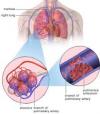 Photo for Pulmonary Embolism – Market Insights, Epidemiology and Market Forecast-2023