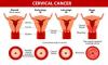 Photo for Cervical Cancer-Market Insights, Epidemiology and Market Forecast-2023- Japan
