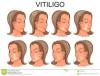 Photo for Vitiligo – Market Insights, Epidemiology and Market Forecast-2023