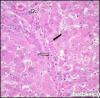 Photo for Alpha- Antitrypsin Deficiency – Market Insights, Epidemiology and Market Forecast-2023