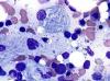 Photo for Gaucher’s disease – Market Insights, Epidemiology and Market Forecast – 2023 – 7MM
