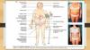 Photo for Cushing’s Syndrome  – Market Insights, Epidemiology and Market Forecast-2023