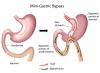 Photo for Bypass Surgery Cost in Chennai