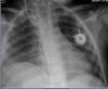 Photo for Global Pediatric Implantable Port Market Professional Survey Report 2017