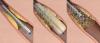 Photo for EMEA (Europe, Middle East and Africa) Coronary Stent Market Report 2017