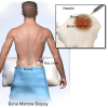Photo for Bone Marrow Transplant Market – Global Industry Insights, Trends