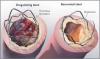 Photo for Global Drug-Eluting Stents Market Research Report 2017