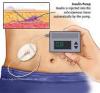 Photo for Global Implantable Insulin Pumps Market Research Report 2017
