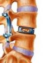 Photo for Global Interbody Fusion Cage Market Research Report 2017