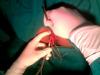 Photo for Piles Surgery cost in Chennai