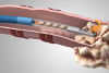 Photo for Biopsy Devices Market - Global Industry Insights, Trends