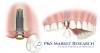 Photo for Dental Implants and Prosthetics Market insight, Industry Analysis and Demand Forecast to 2022
