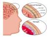 Photo for Meningococcal Disease Treatment Market Set for Rapid Growth by 2024