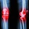 Photo for Global Cartilage Repair and Regeneration Market, by Treatment Modalities (Cell-Based Approach, Non-Cell-Based Approach), by Procedure Type, by Application Outlook 2022