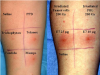 Photo for Antigen Skin Test Market Predicted Double-Digit Growth Rate by 2024