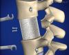 Photo for Bone Graft Substitutes Market - Global Industry Insights, Trends, Outlook and Analysis, 2017 - 2025