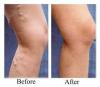 Photo for Global Varicose Vein Treatment Market Report, Countries, Type and Application, Forecast to 2022