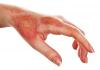 Photo for Burn Care Market forecast to witness phenomenal growth opportunities by 2024